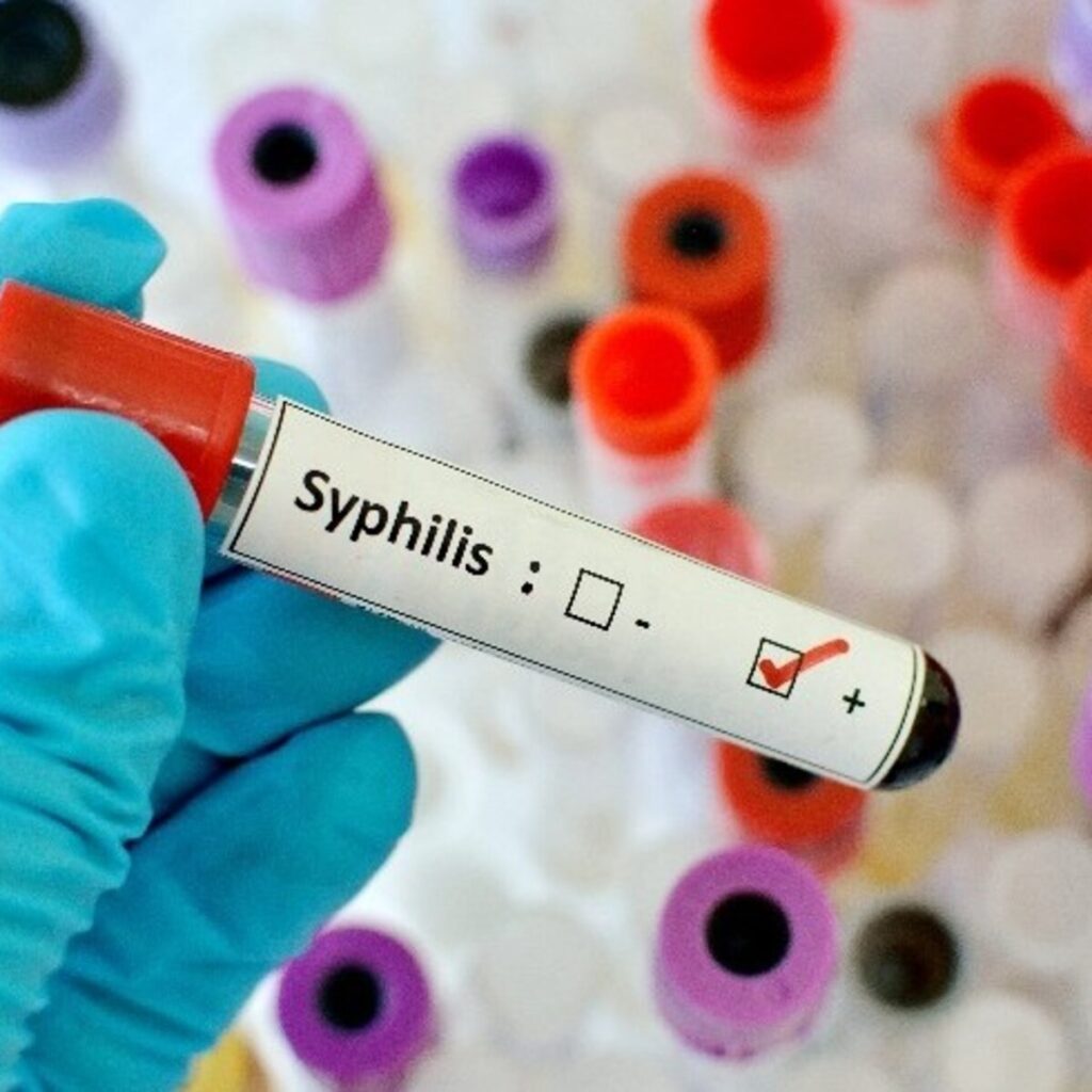 sifilis